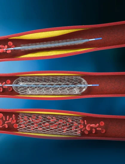 PCI